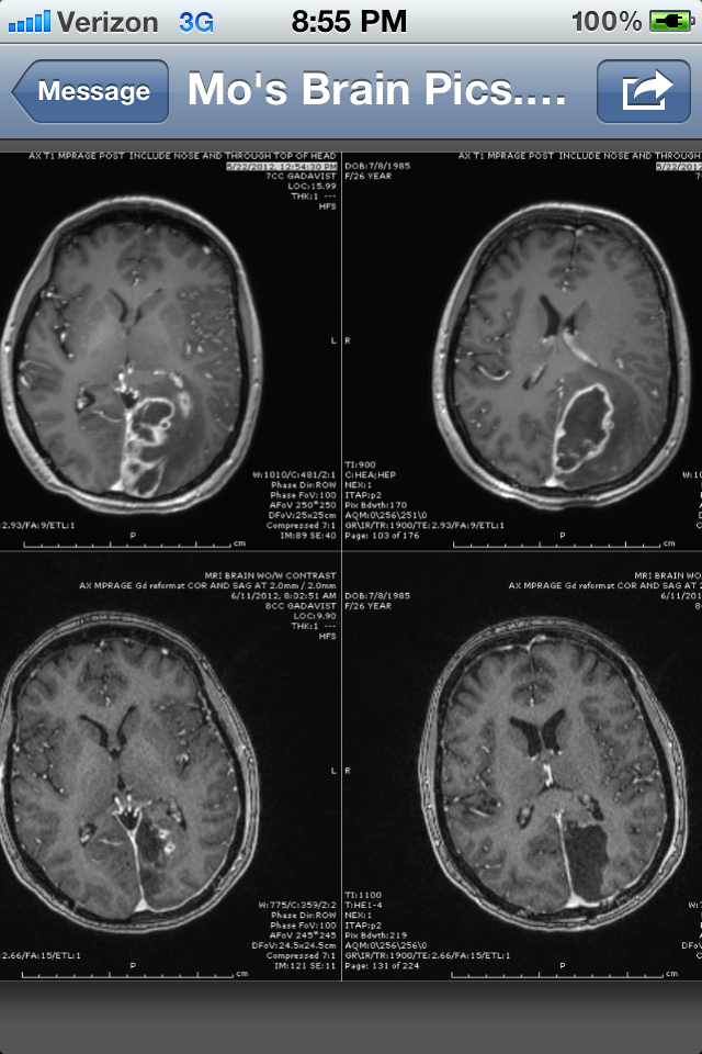 MRi pre-cranitomy (top) and post-craniotomy (bottom).  You can see the infection in the white, and then where they removed it.  Notice how much swelling was present before my surgeries.